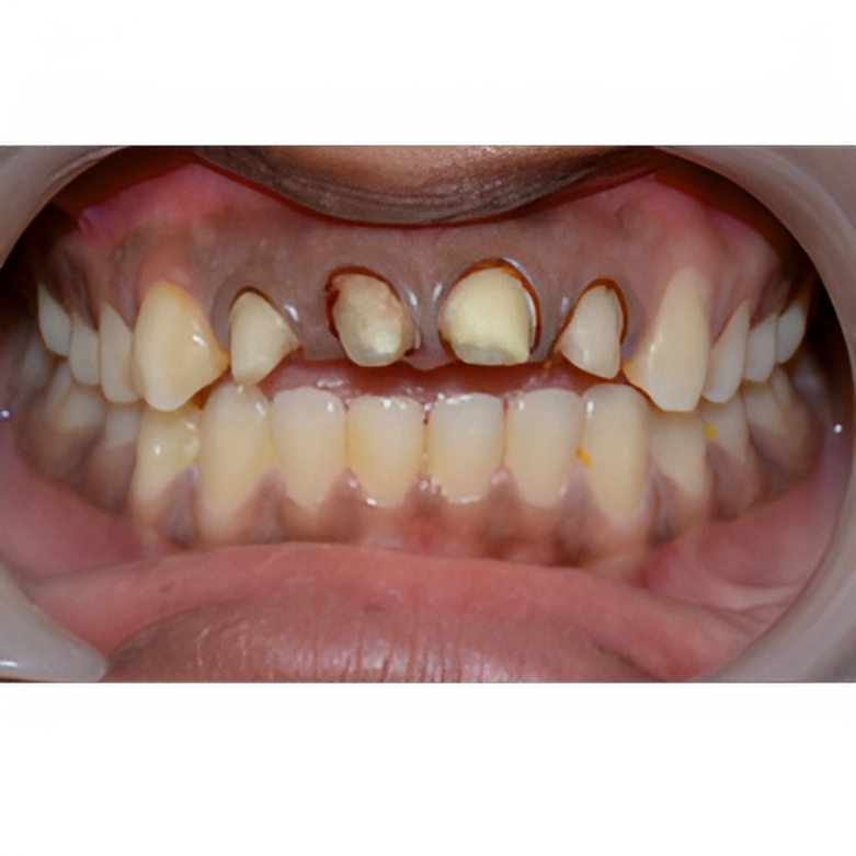 Root Canal Restoration in Moshi – Crown & Strength